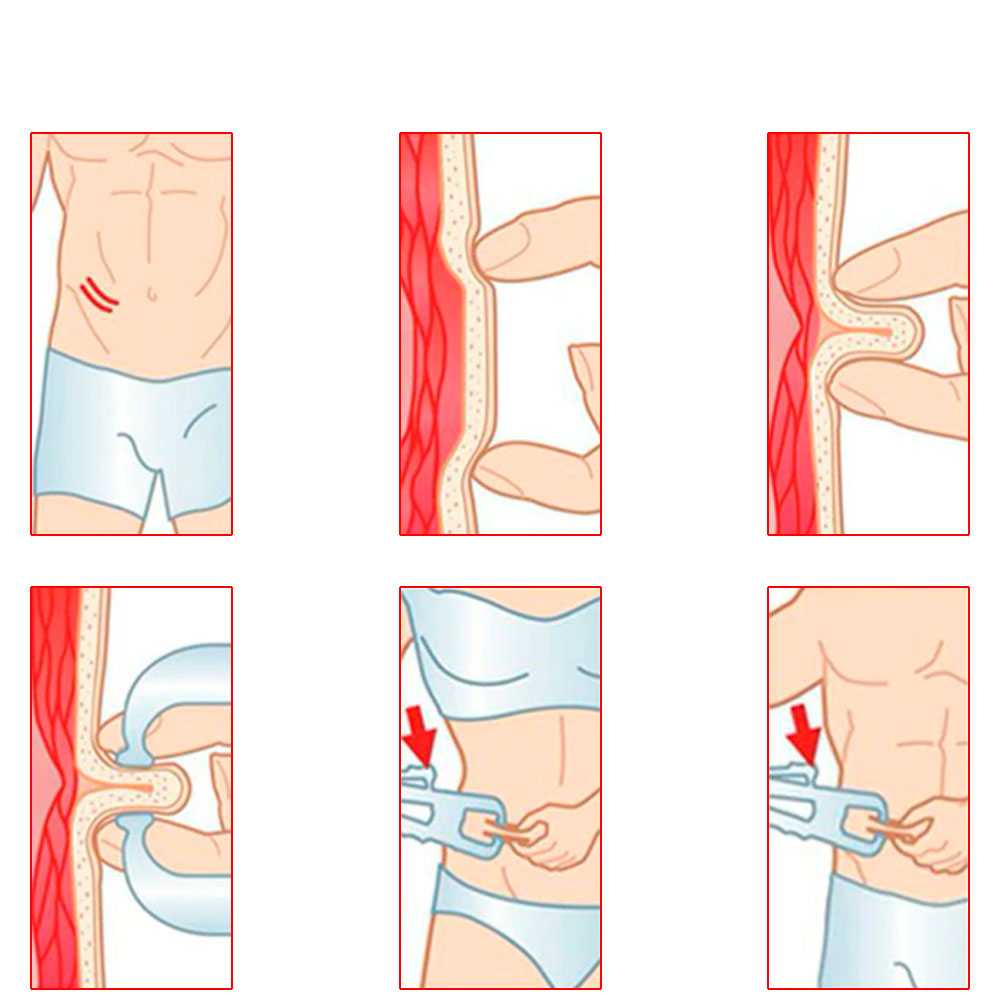 Medidor de Grasa Corporal Blanco Calibrador Calibre Adipómetro Lipocalibre Medidora IMC Manual Alta Precisión Pinza